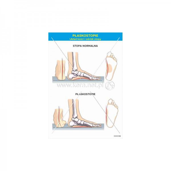 Płaskostopie - układ kości i odcisk stopy plansza 70x100 cm